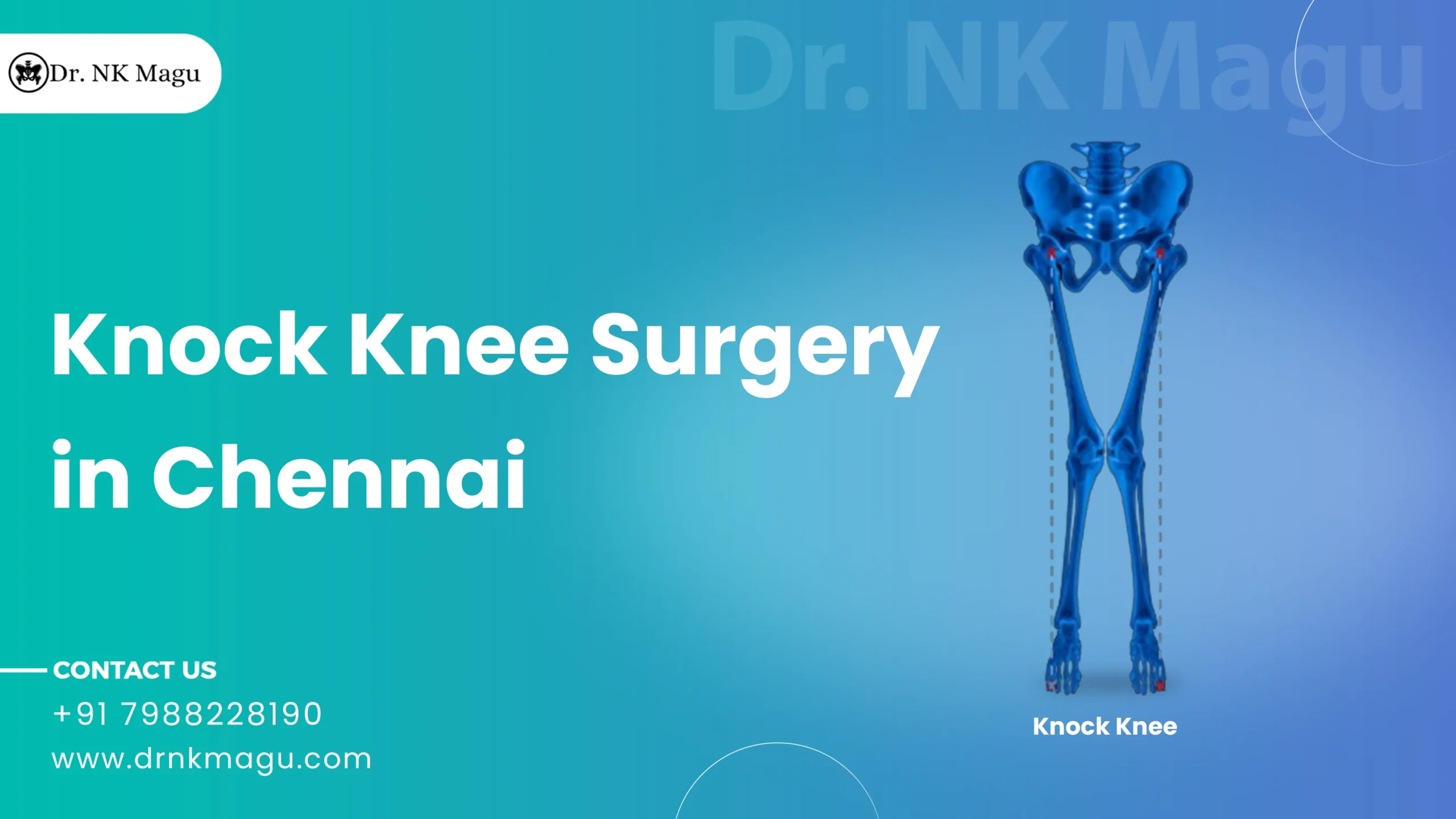 Knock Knee Surgery Cost in Chennai