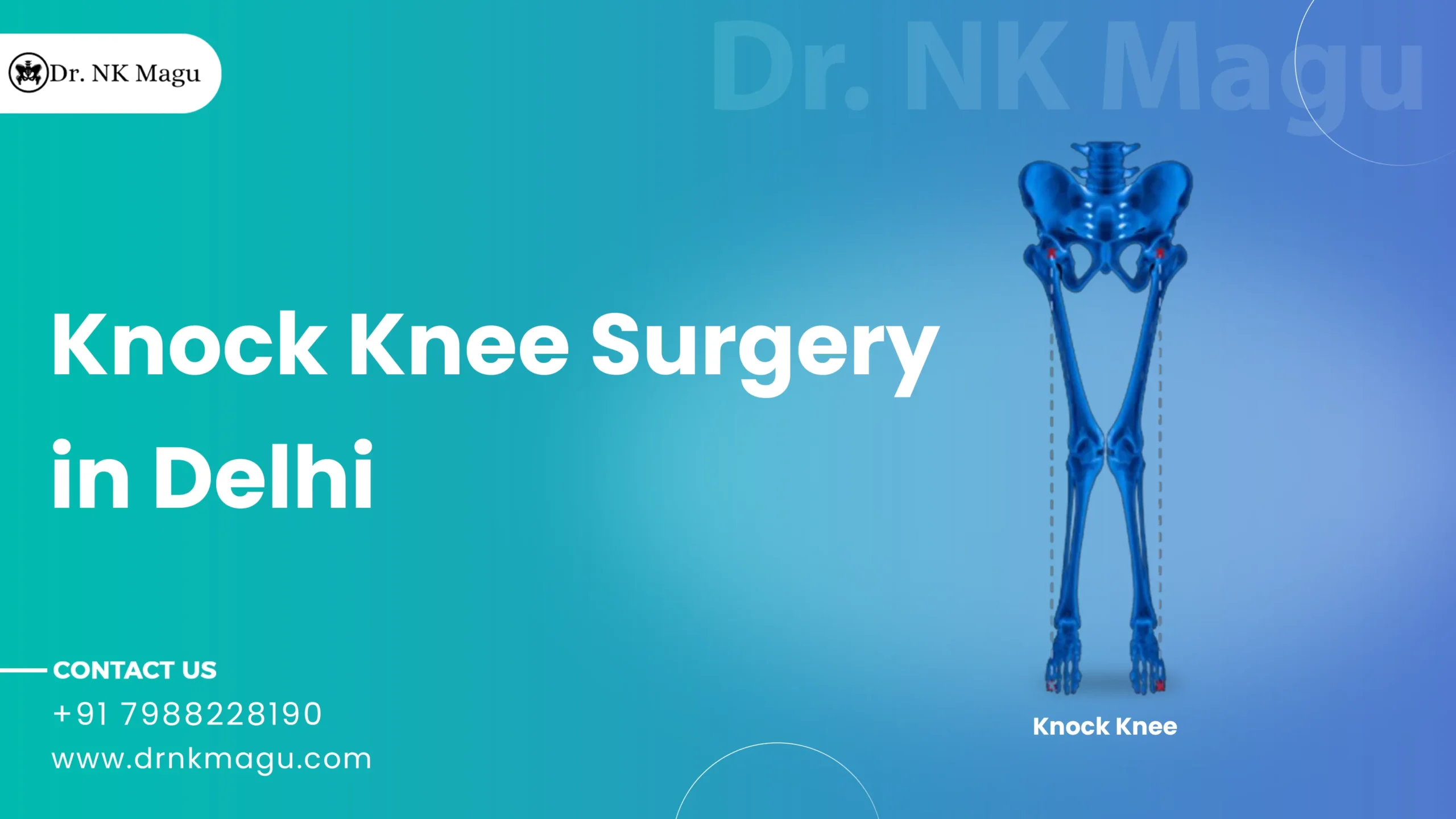 Knock Knee Surgery Cost in Delhi