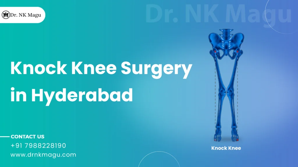 Knock Knee Surgery Cost in Hyderabad