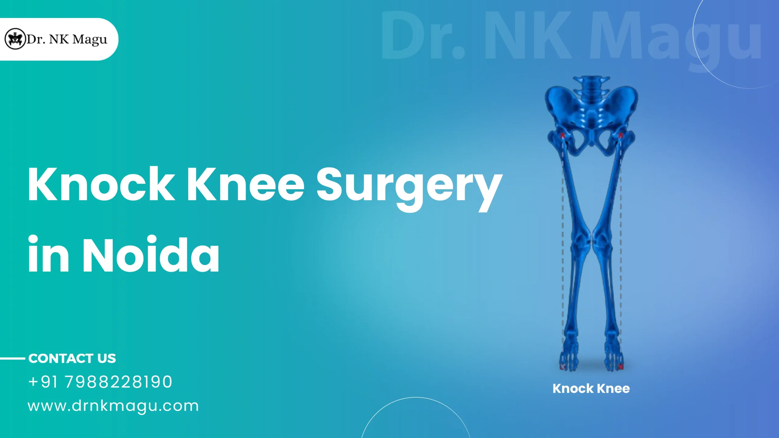 Knock Knee Surgery Cost in Noida