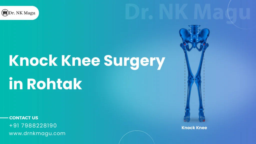 Knock Knee Surgery Cost in Rohtak