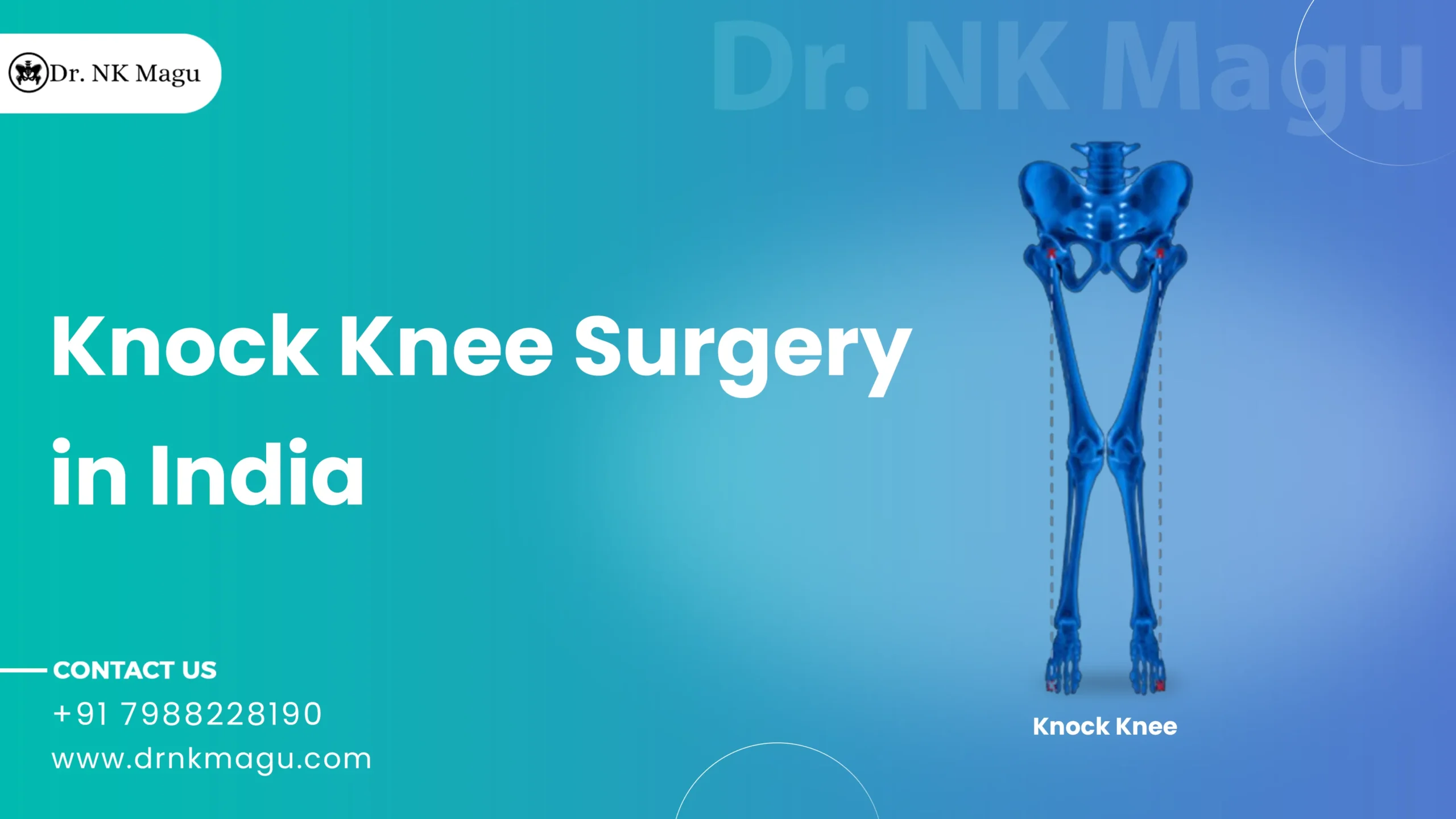 Knock Knee Surgery Cost in India