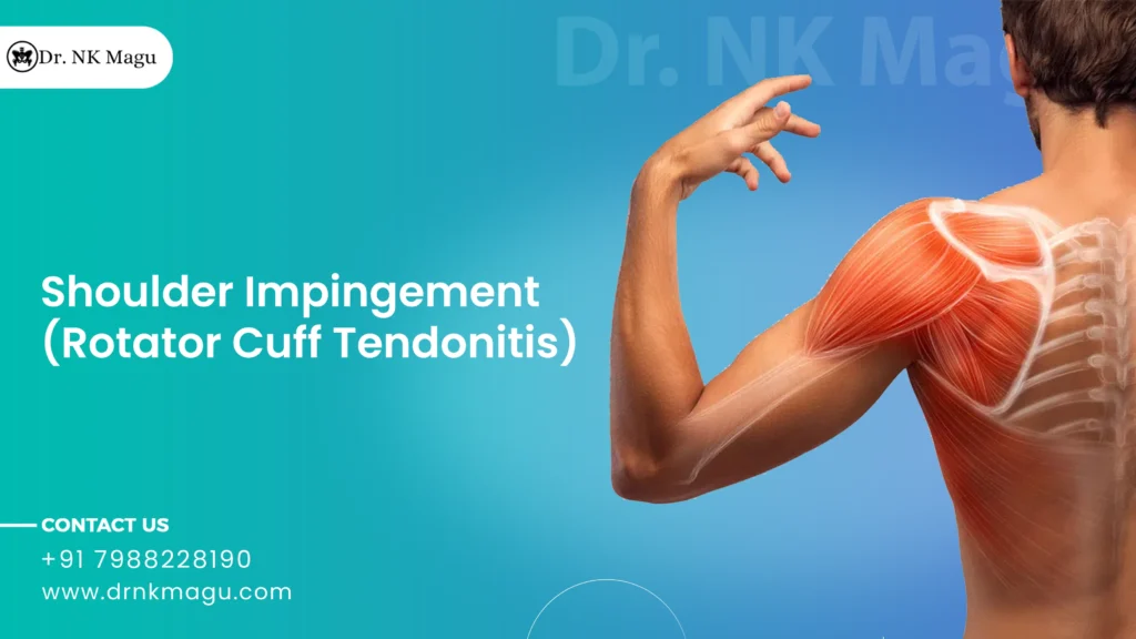 Shoulder Impingement (Rotator Cuff Tendonitis)