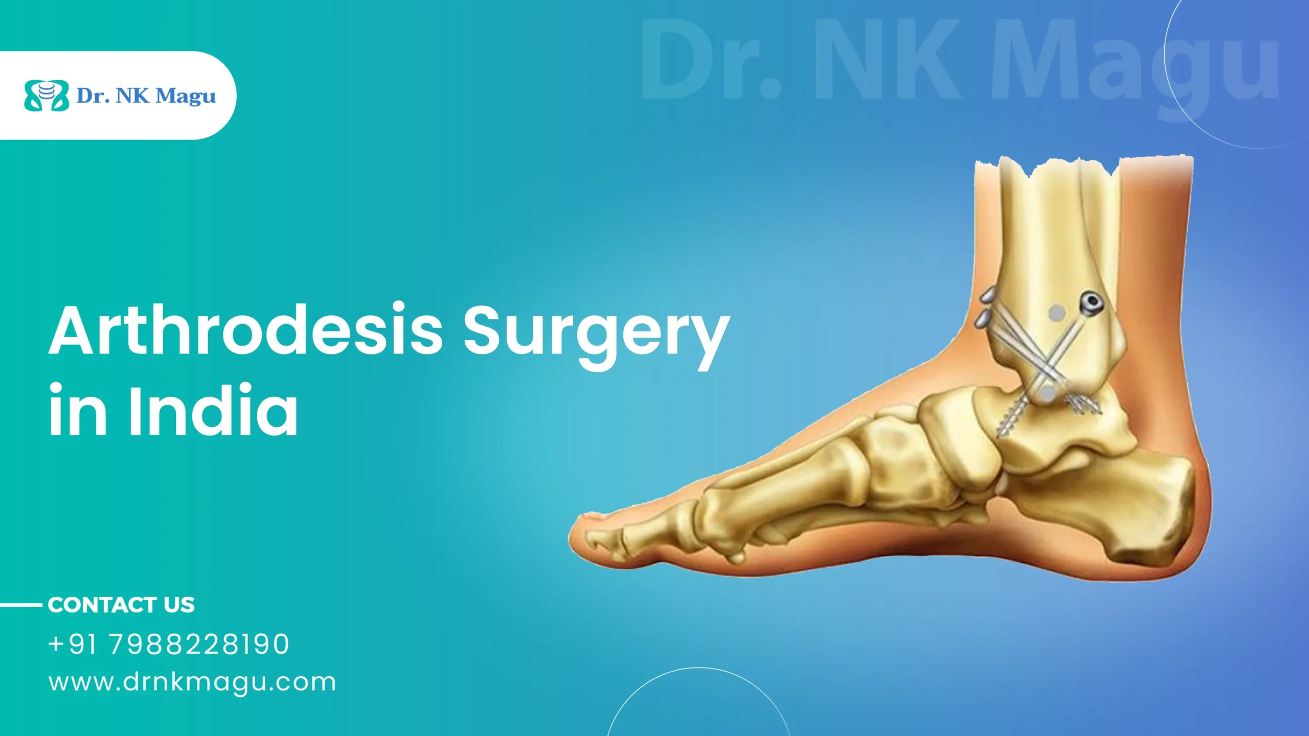 Arthrodesis Surgery in Cost India